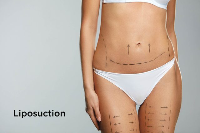 liposuction