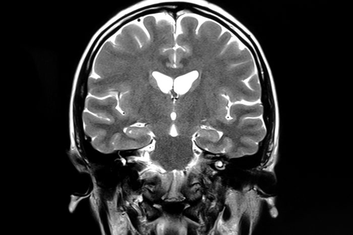 MRI scan of human brain