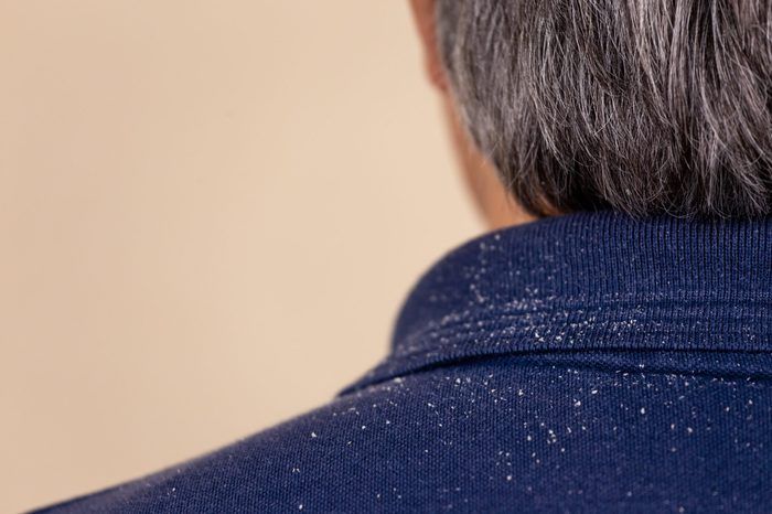 Close-up view of a man who has a lot of dandruff from his hair on his shirt and shoulders.