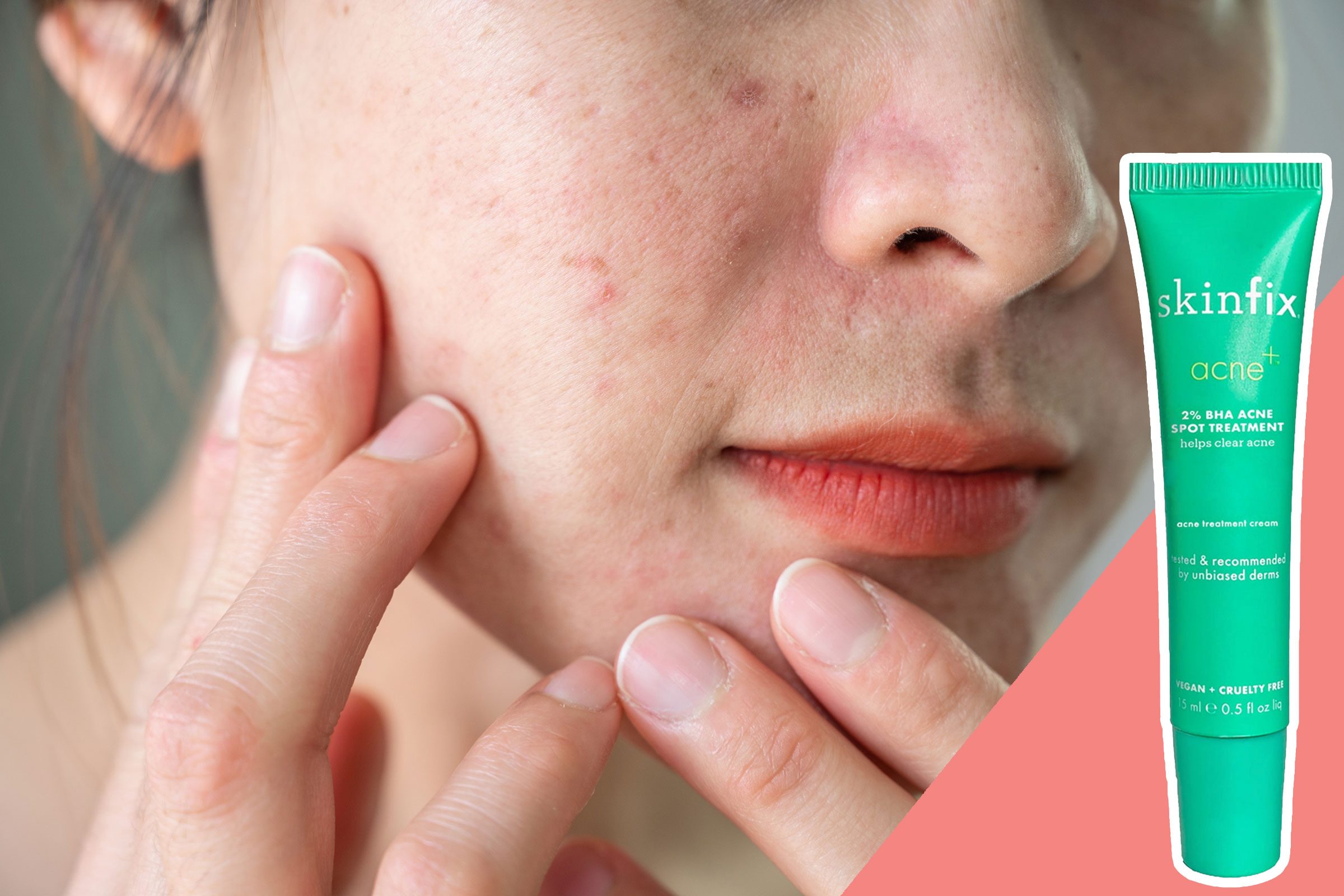 Treat acne gently and effectively
